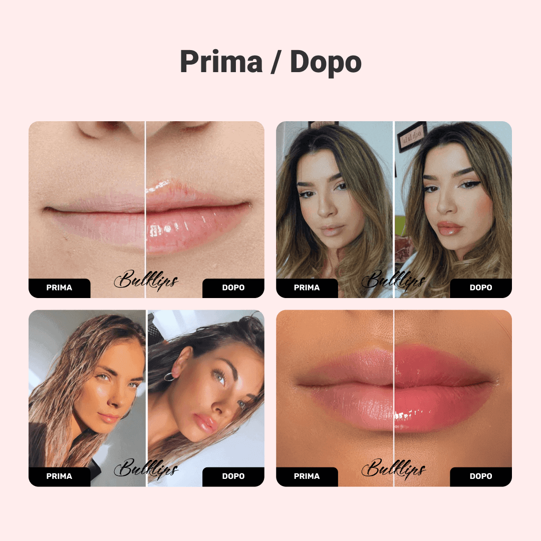 Bulklips - Labbra più carnose - nessuna iniezione - immagine 2