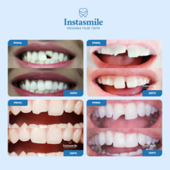 Alternative view of Kit per la Riparazione dei Denti InstaSmile